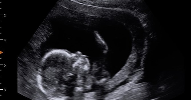 Ultrasound